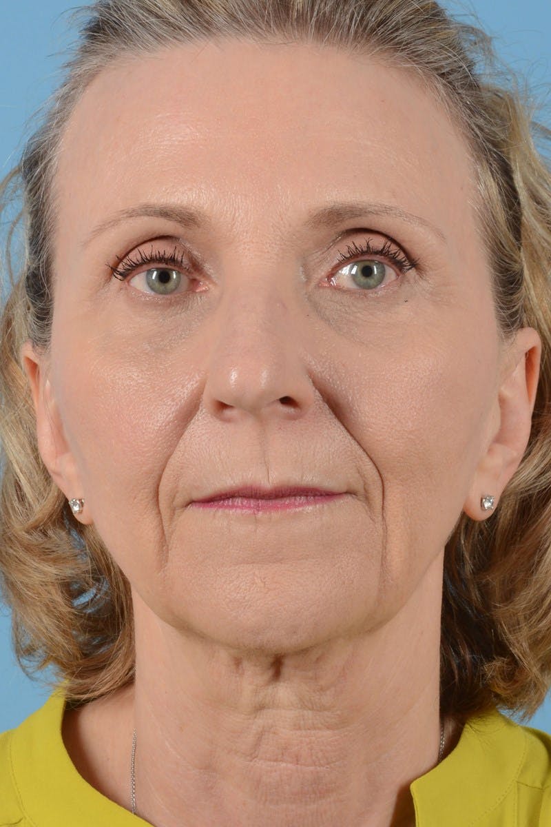 Endoscopic Brow Lift Before & After Gallery - Patient 177960 - Image 3