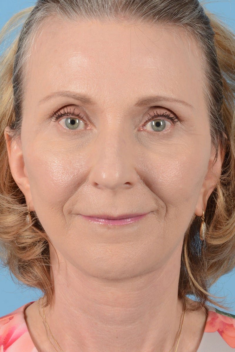 Endoscopic Brow Lift Before & After Gallery - Patient 177960 - Image 4