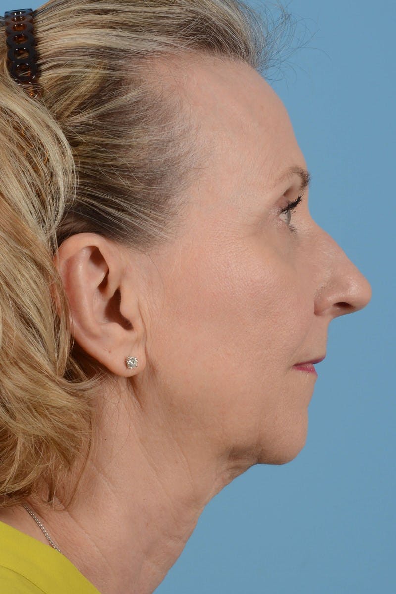 Endoscopic Brow Lift Before & After Gallery - Patient 177960 - Image 5