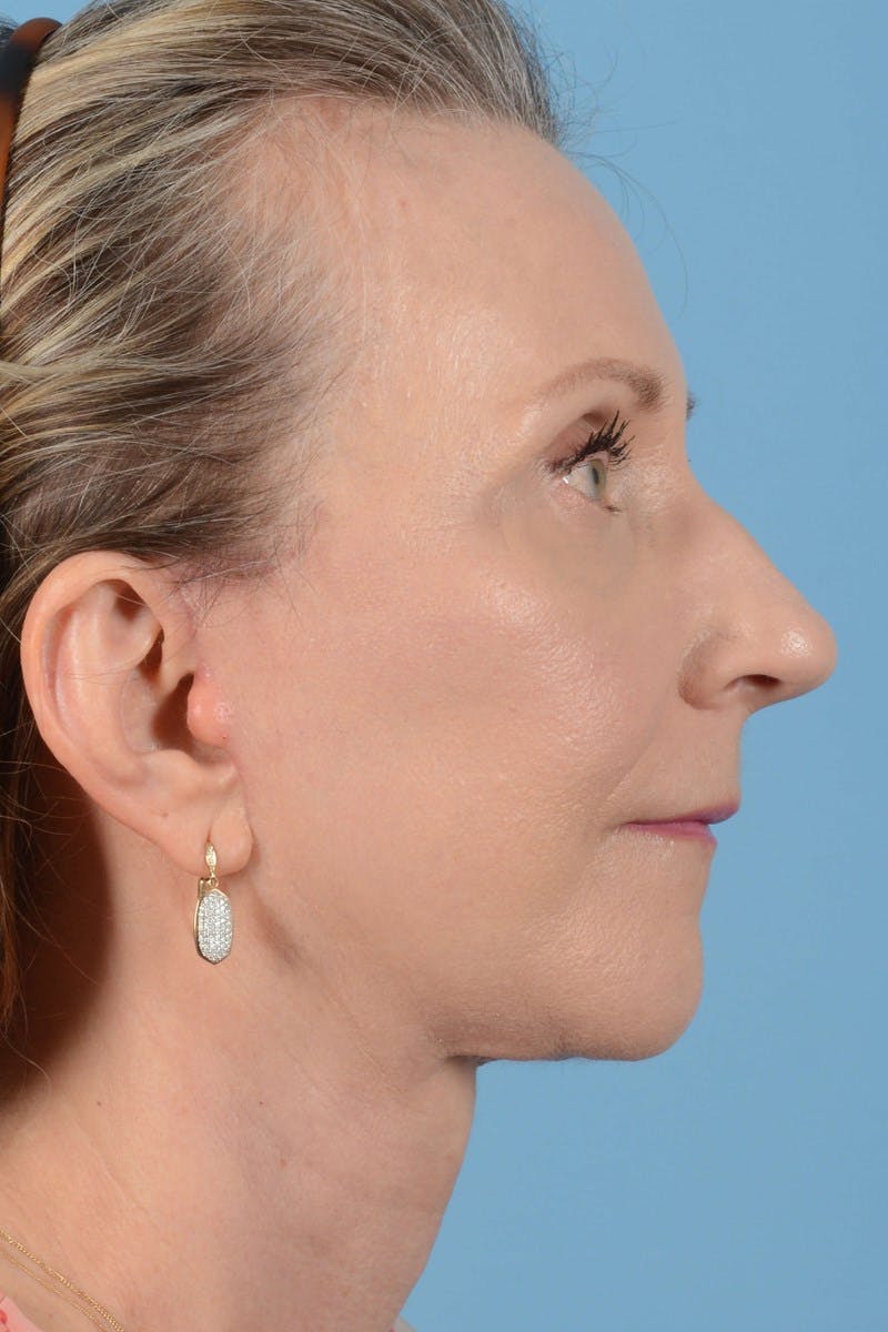 Endoscopic Brow Lift Before & After Gallery - Patient 177960 - Image 6