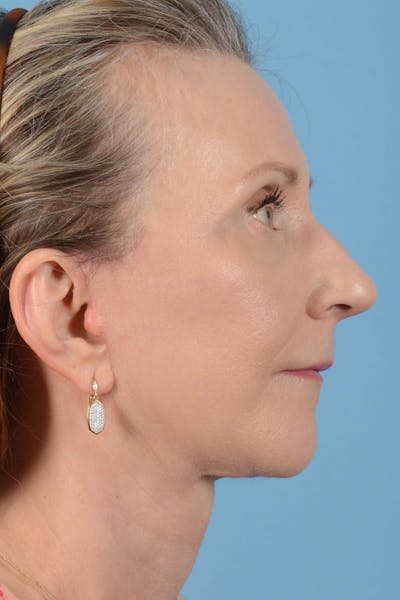 Endoscopic Brow Lift Before & After Gallery - Patient 177960 - Image 6