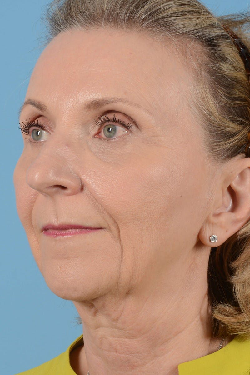 Endoscopic Brow Lift Before & After Gallery - Patient 177960 - Image 7