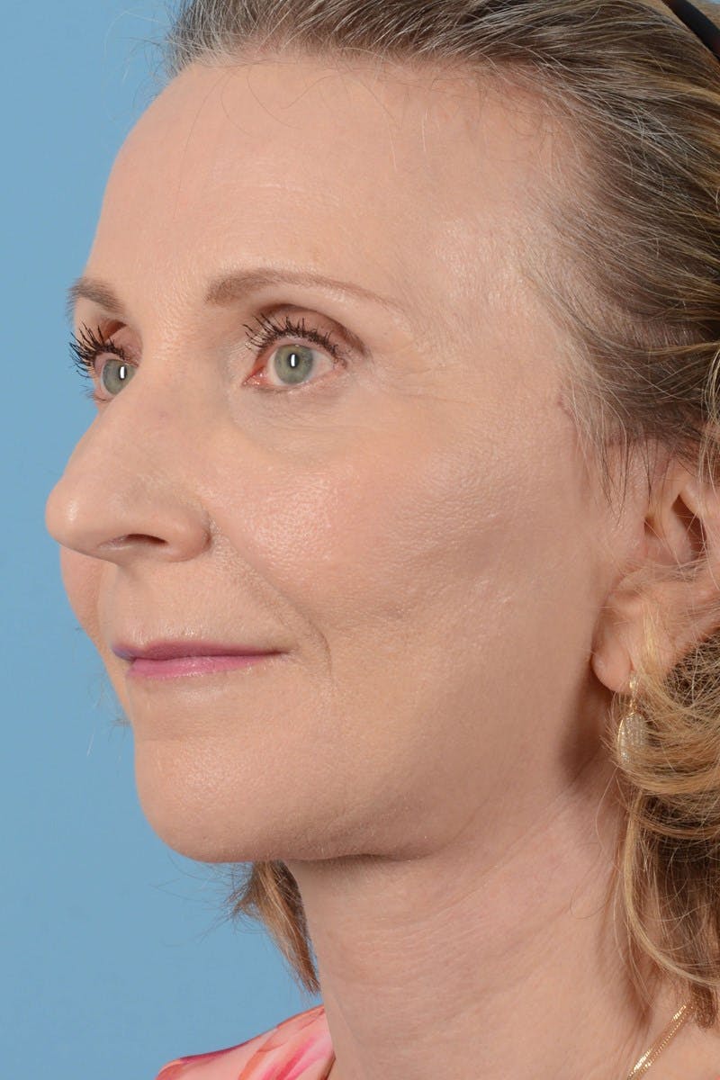 Endoscopic Brow Lift Before & After Gallery - Patient 177960 - Image 8