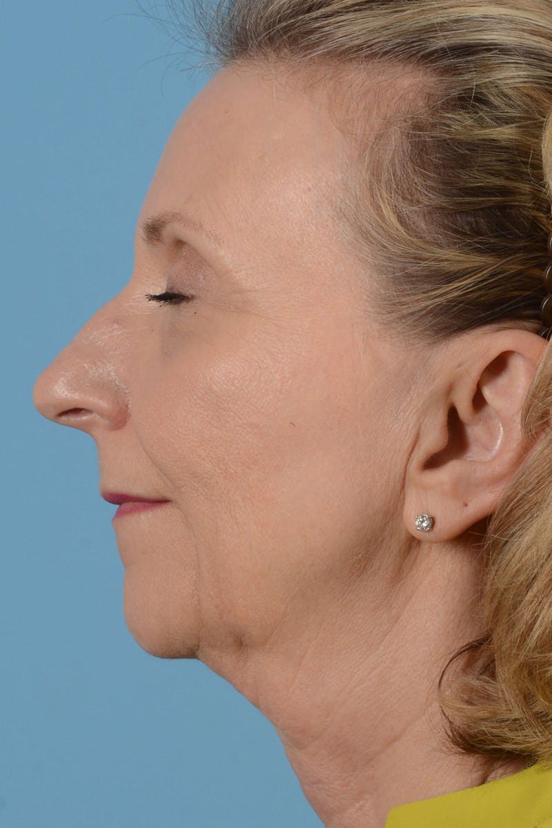 Endoscopic Brow Lift Before & After Gallery - Patient 177960 - Image 9