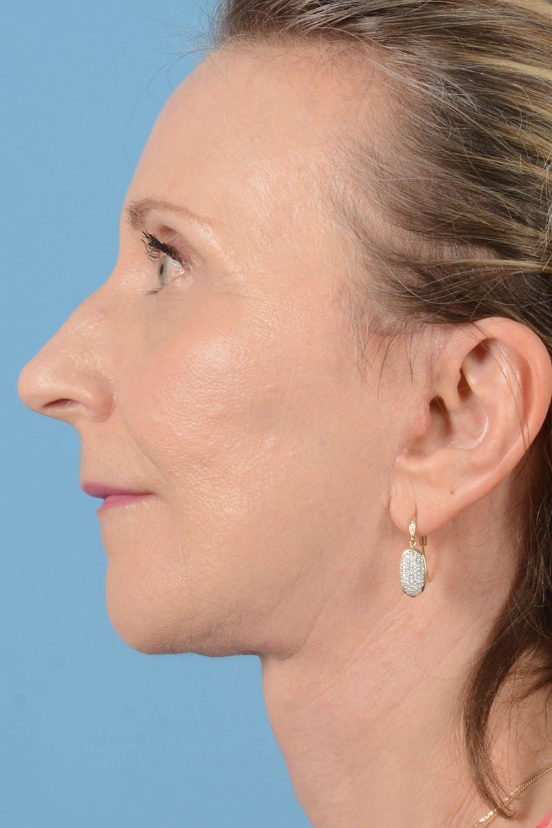 Endoscopic Brow Lift Before & After Gallery - Patient 177960 - Image 10