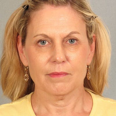 Endoscopic Brow Lift Before & After Gallery - Patient 392611 - Image 1