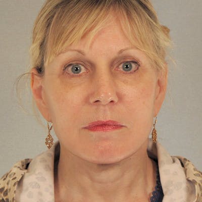 Endoscopic Brow Lift Before & After Gallery - Patient 392611 - Image 2