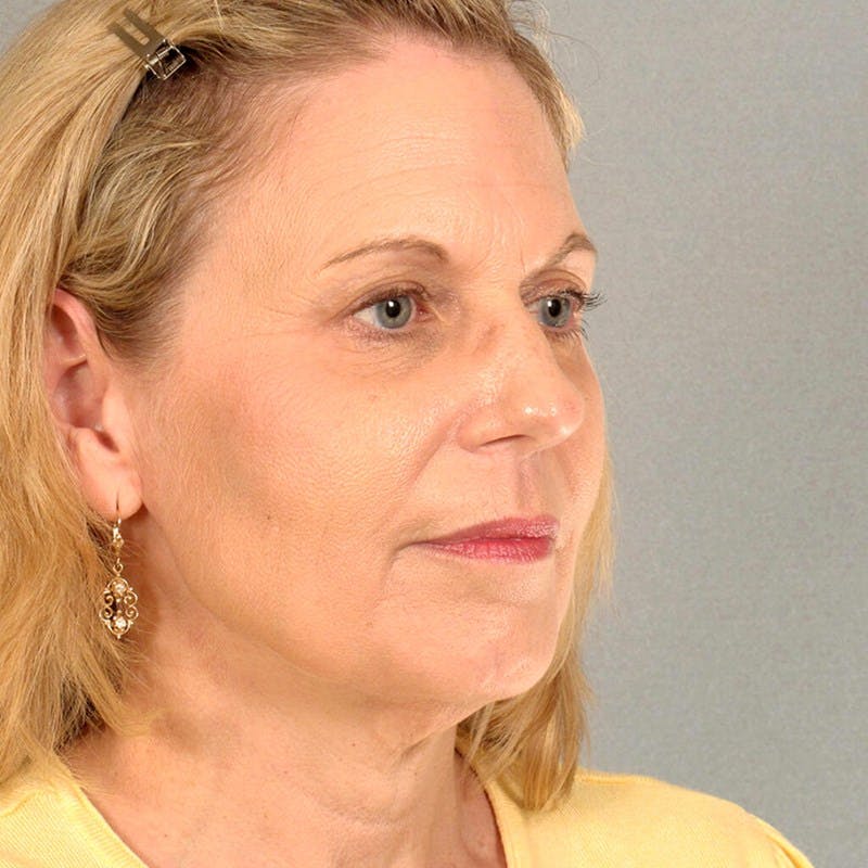 Endoscopic Brow Lift Before & After Gallery - Patient 392611 - Image 3
