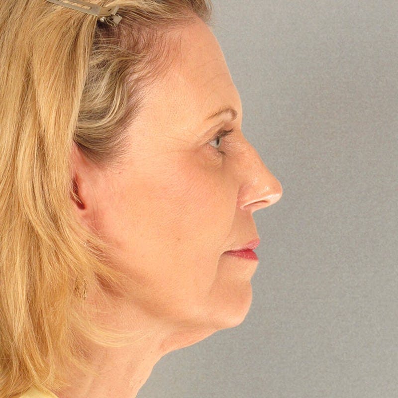 Endoscopic Brow Lift Before & After Gallery - Patient 392611 - Image 5