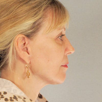 Endoscopic Brow Lift Before & After Gallery - Patient 392611 - Image 6