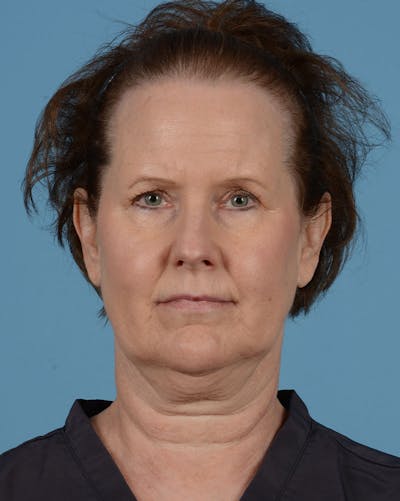 Endoscopic Brow Lift Before & After Gallery - Patient 199075 - Image 1
