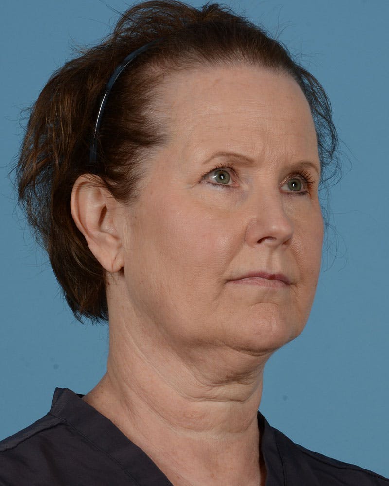 Endoscopic Brow Lift Before & After Gallery - Patient 199075 - Image 3