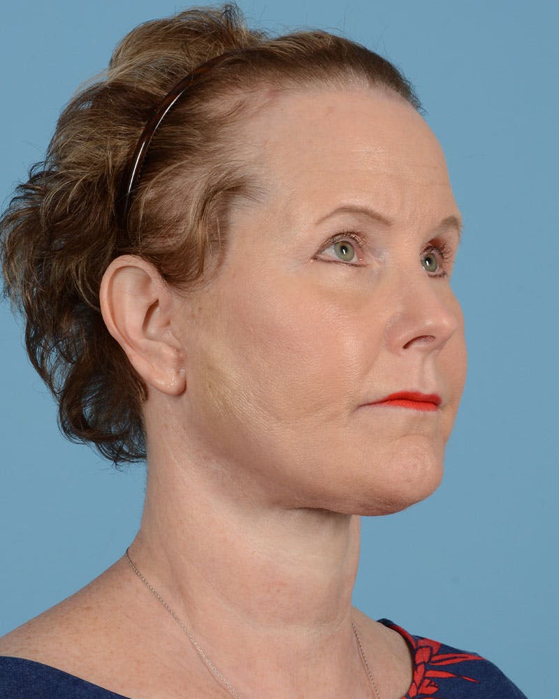 Endoscopic Brow Lift Before & After Gallery - Patient 199075 - Image 4