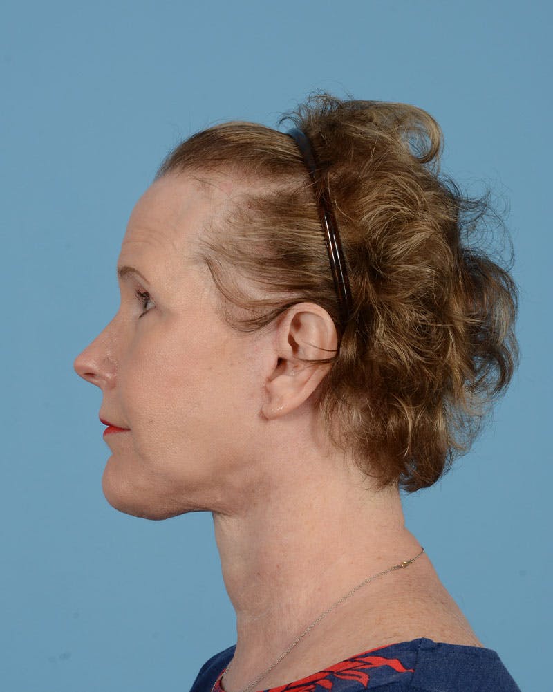 Endoscopic Brow Lift Before & After Gallery - Patient 199075 - Image 8