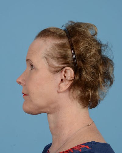 Endoscopic Brow Lift Before & After Gallery - Patient 199075 - Image 8