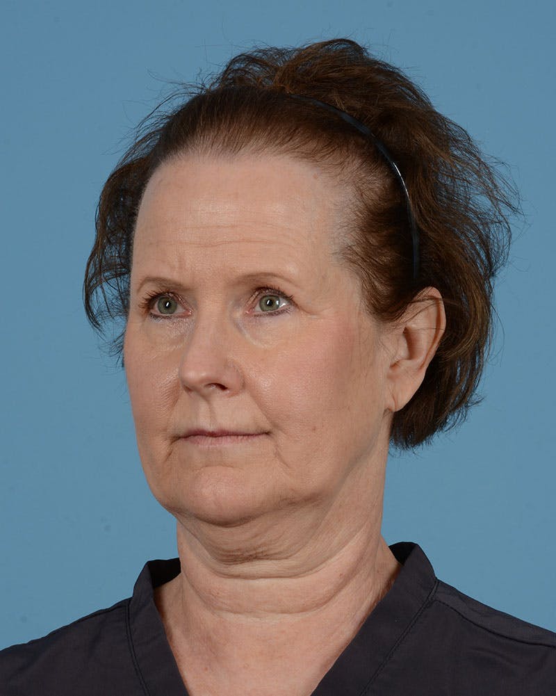Endoscopic Brow Lift Before & After Gallery - Patient 199075 - Image 9