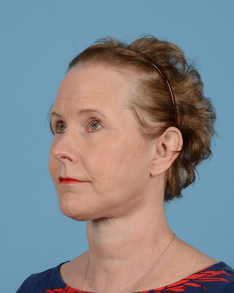 Endoscopic Brow Lift Before & After Gallery - Patient 199075 - Image 10