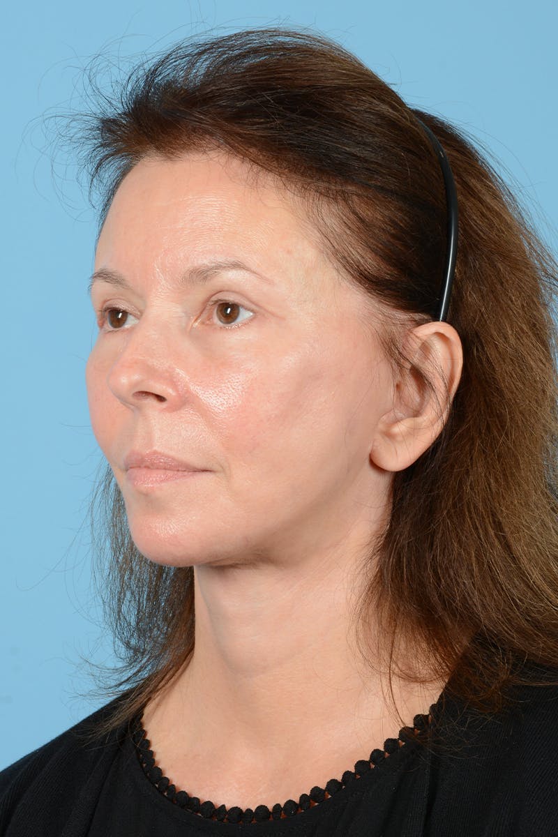 Endoscopic Brow Lift Before & After Gallery - Patient 390672 - Image 4