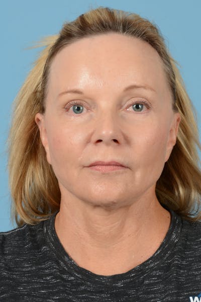 Endoscopic Brow Lift Before & After Gallery - Patient 129683 - Image 2