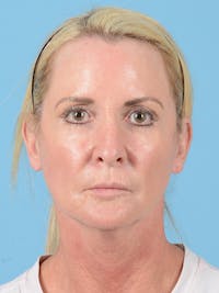 Endoscopic Brow Lift Before & After Gallery - Patient 867028 - Image 1