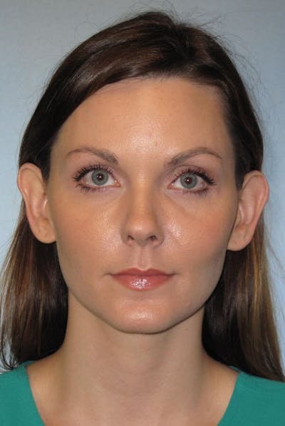 Ear Surgery Before & After Gallery - Patient 115341 - Image 1