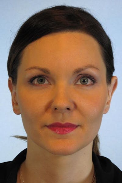 Ear Surgery Before & After Gallery - Patient 115341 - Image 2