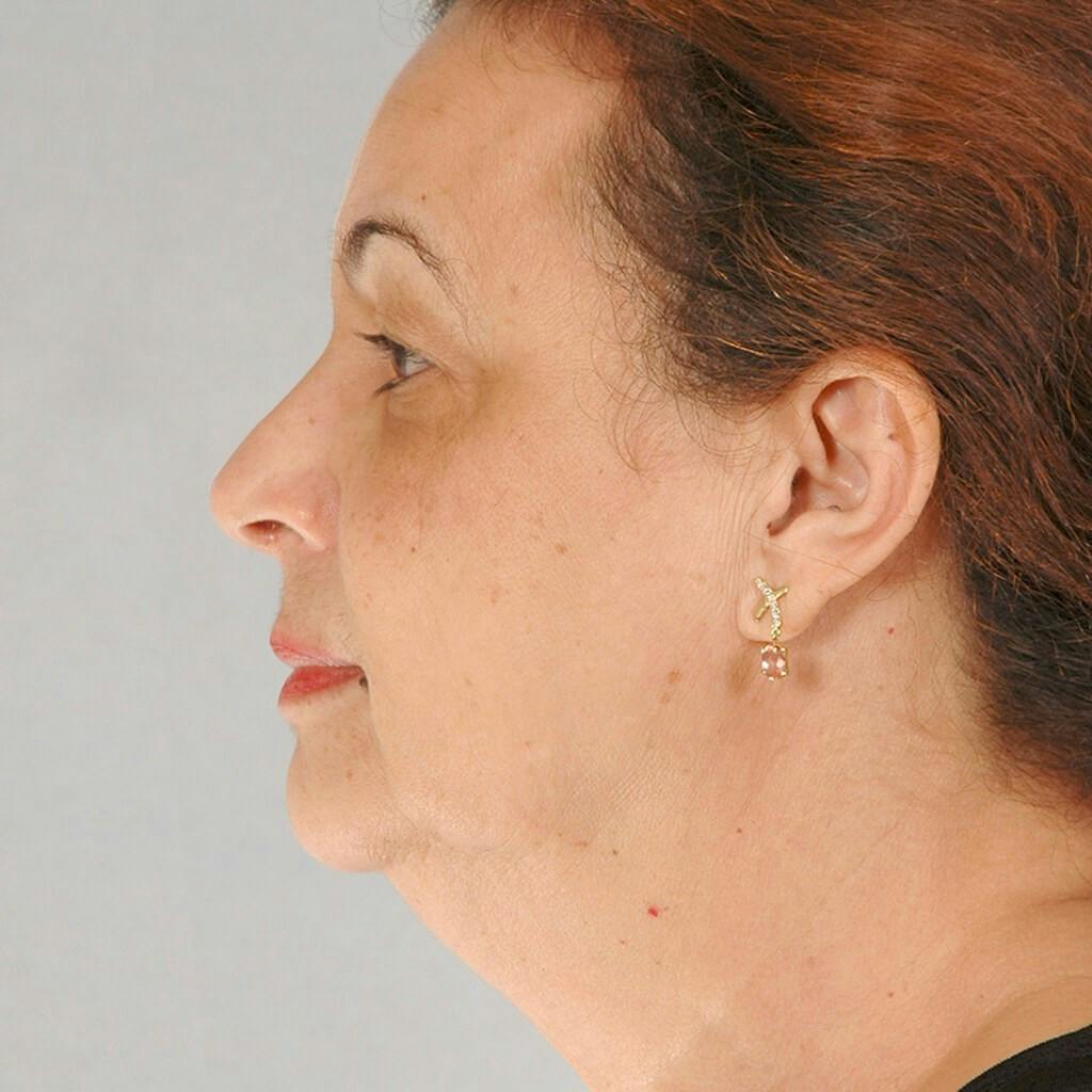 Ear Surgery Before & After Gallery - Patient 284584 - Image 5