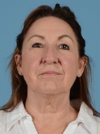 Ear Surgery Before & After Gallery - Patient 241856 - Image 1