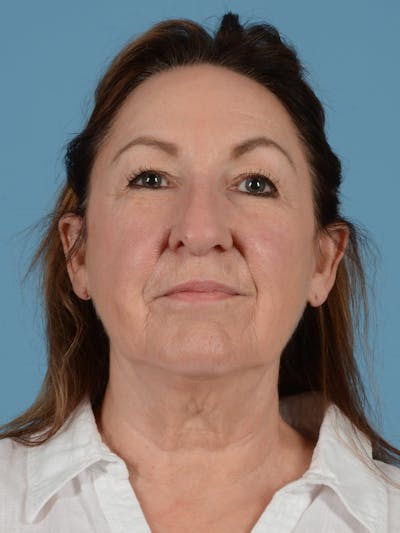 Ear Surgery Before & After Gallery - Patient 241856 - Image 1
