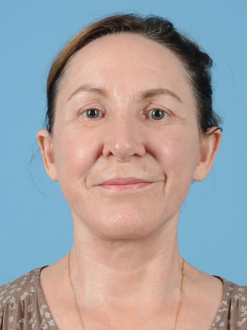 Ear Surgery Before & After Gallery - Patient 241856 - Image 2