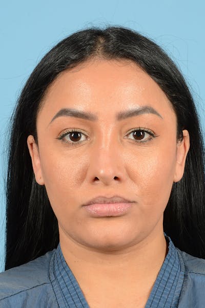 Eyelid Lift Before & After Gallery - Patient 343939 - Image 1