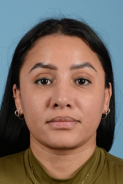 Eyelid Lift Before & After Gallery - Patient 343939 - Image 2