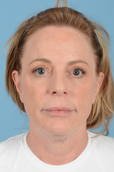 Facelift Before & After Gallery - Patient 414305 - Image 1