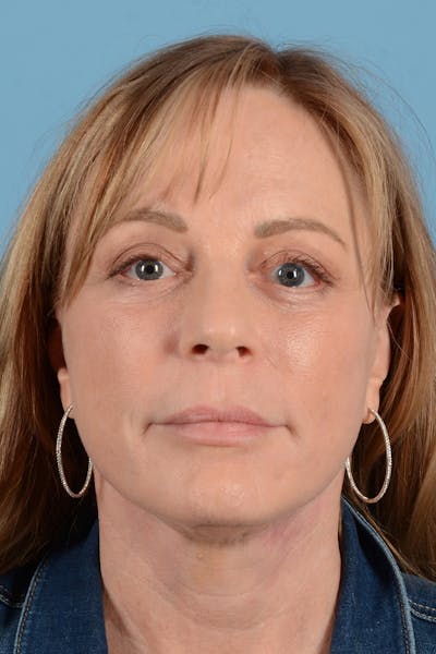 Facelift Before & After Gallery - Patient 414305 - Image 2