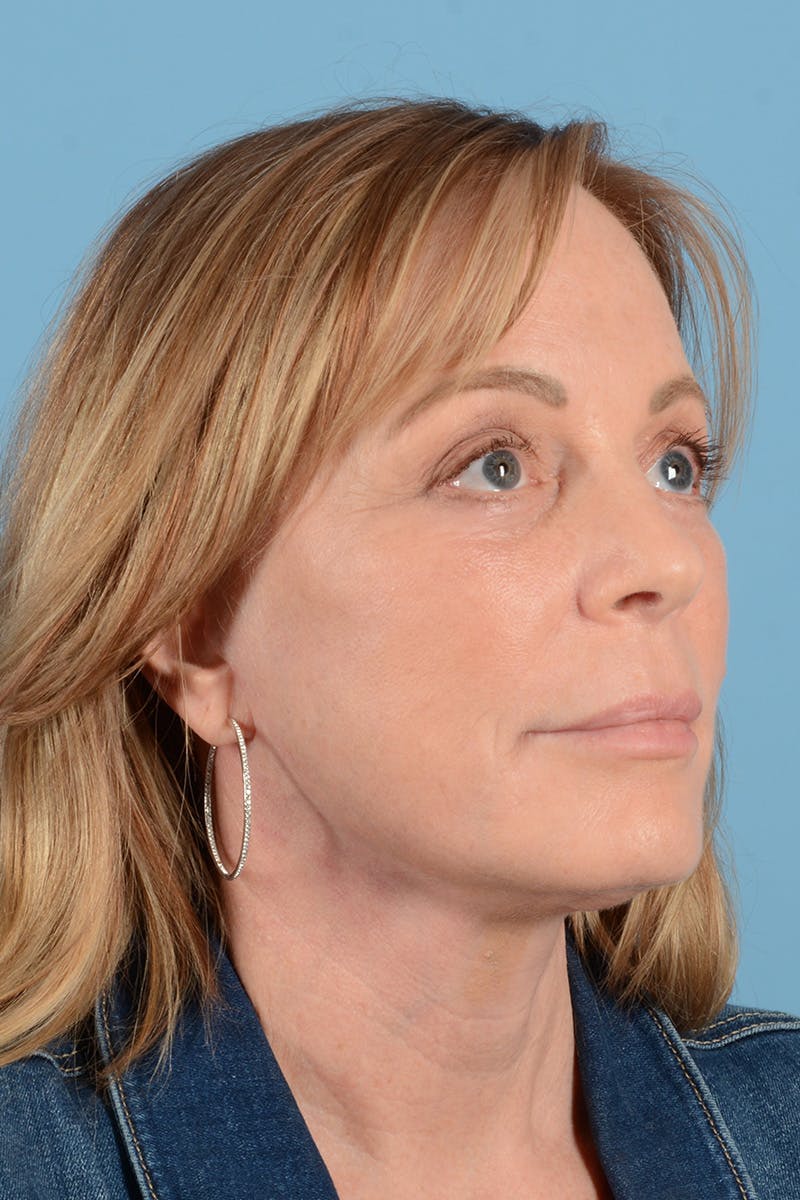 Facelift Before & After Gallery - Patient 414305 - Image 4