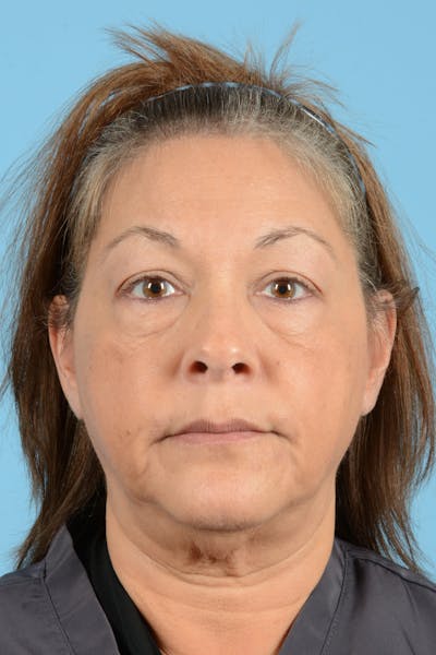 Eyelid Lift Before & After Gallery - Patient 192254 - Image 1