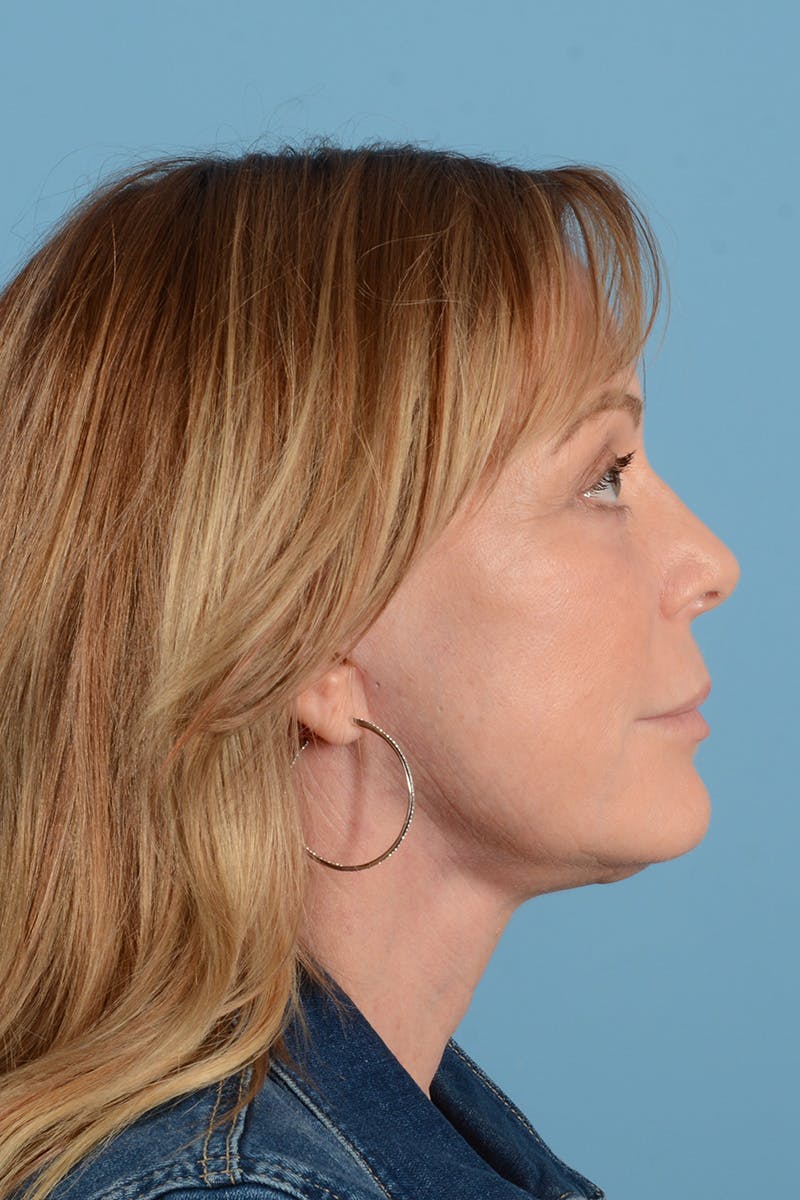 Facelift Before & After Gallery - Patient 414305 - Image 6