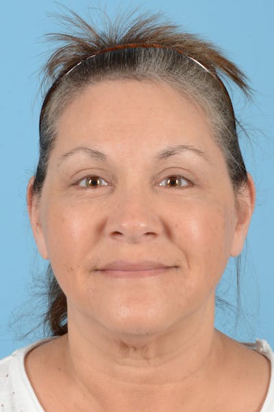 Eyelid Lift Before & After Gallery - Patient 192254 - Image 2