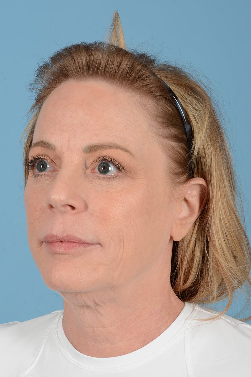 Facelift Before & After Gallery - Patient 414305 - Image 7