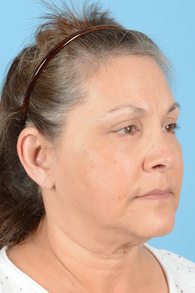 Eyelid Lift Before & After Gallery - Patient 192254 - Image 4