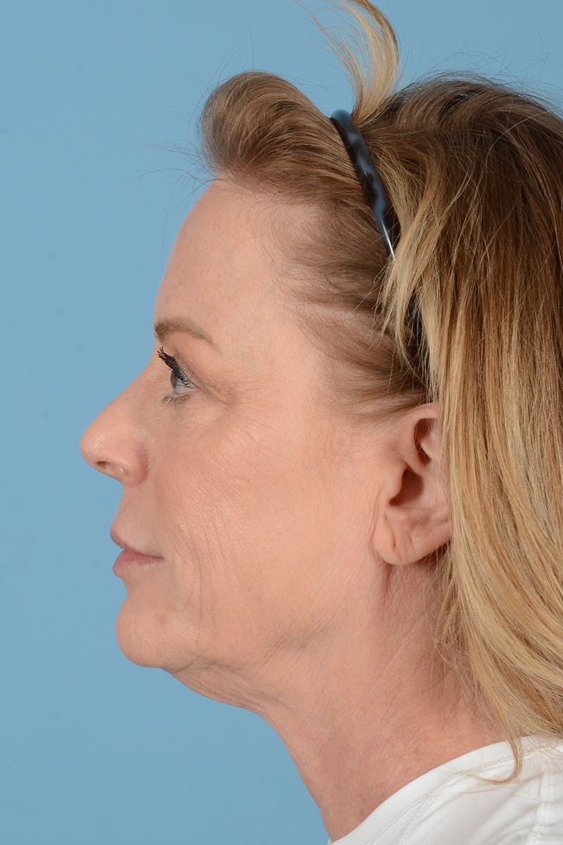 Facelift Before & After Gallery - Patient 414305 - Image 9