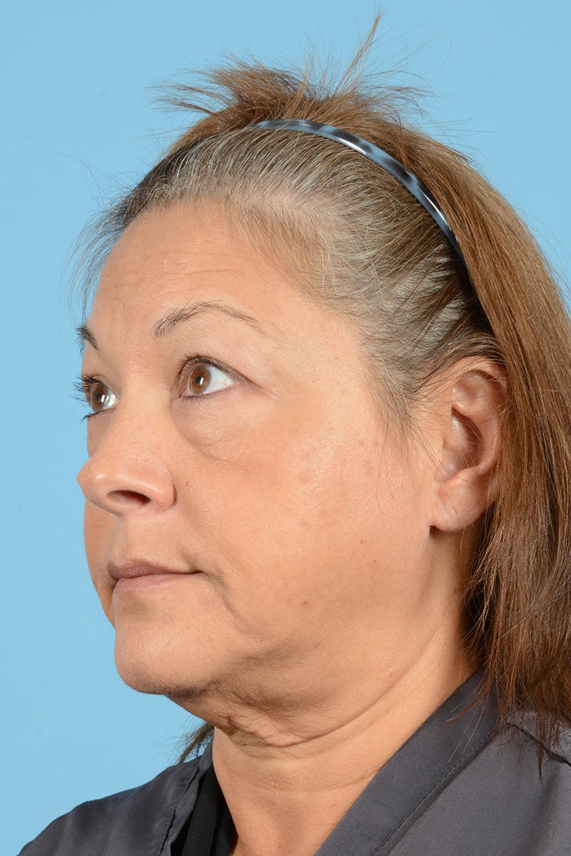 Eyelid Lift Before & After Gallery - Patient 192254 - Image 5