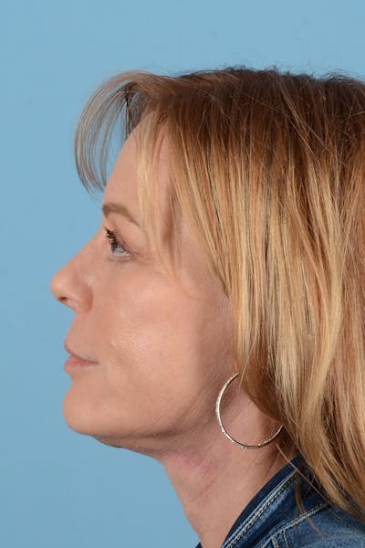 Facelift Before & After Gallery - Patient 414305 - Image 10