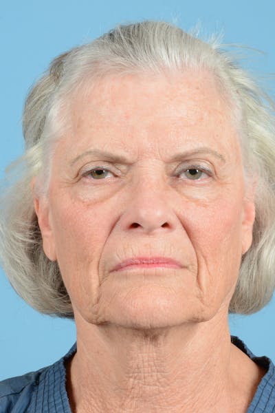 Facelift Before & After Gallery - Patient 734536 - Image 1