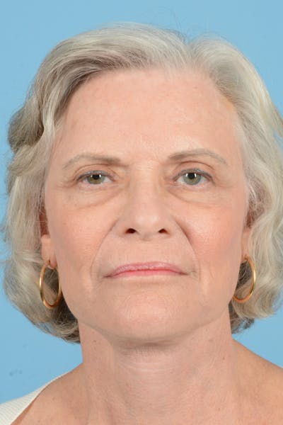Facelift Before & After Gallery - Patient 734536 - Image 2