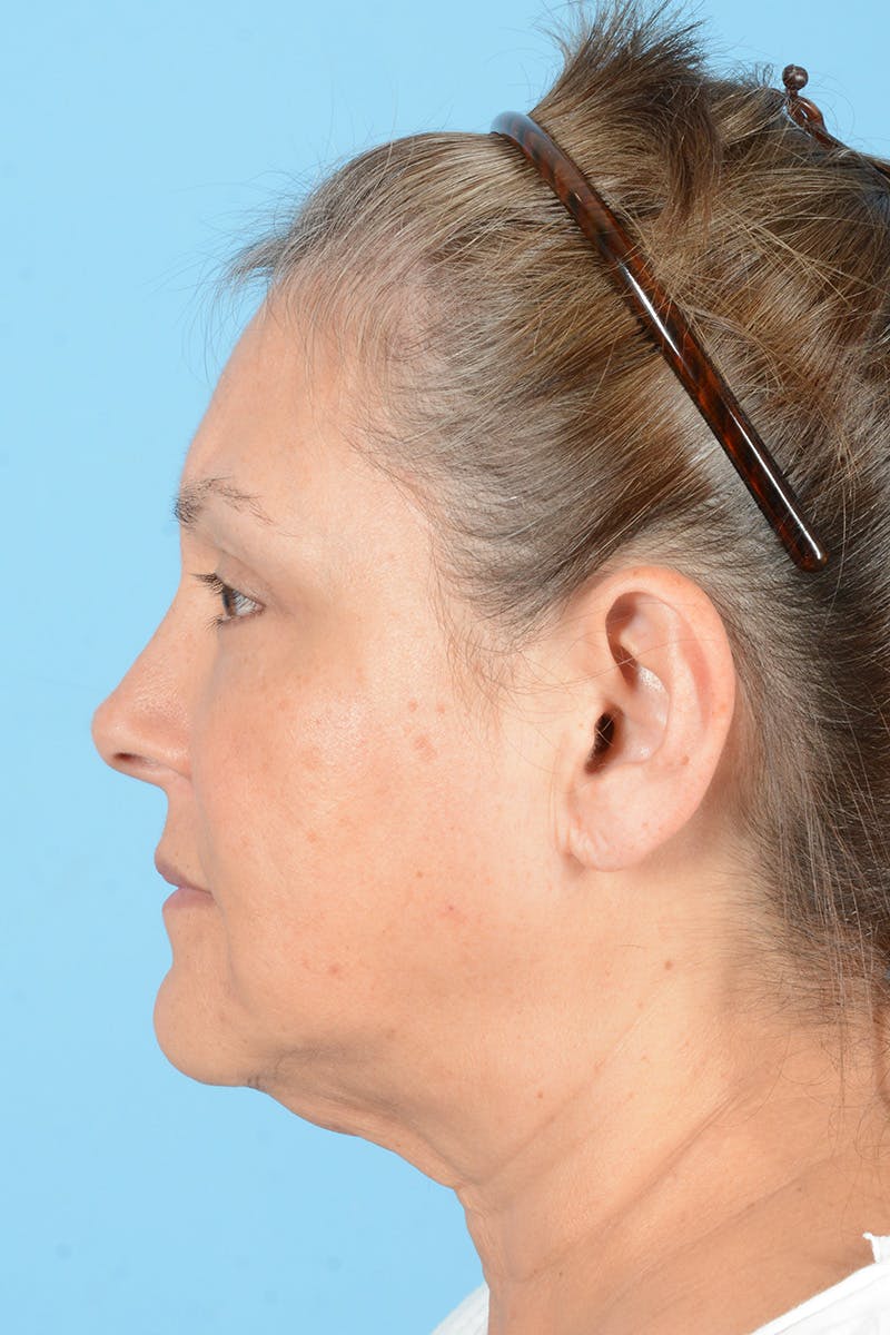 Eyelid Lift Before & After Gallery - Patient 192254 - Image 8