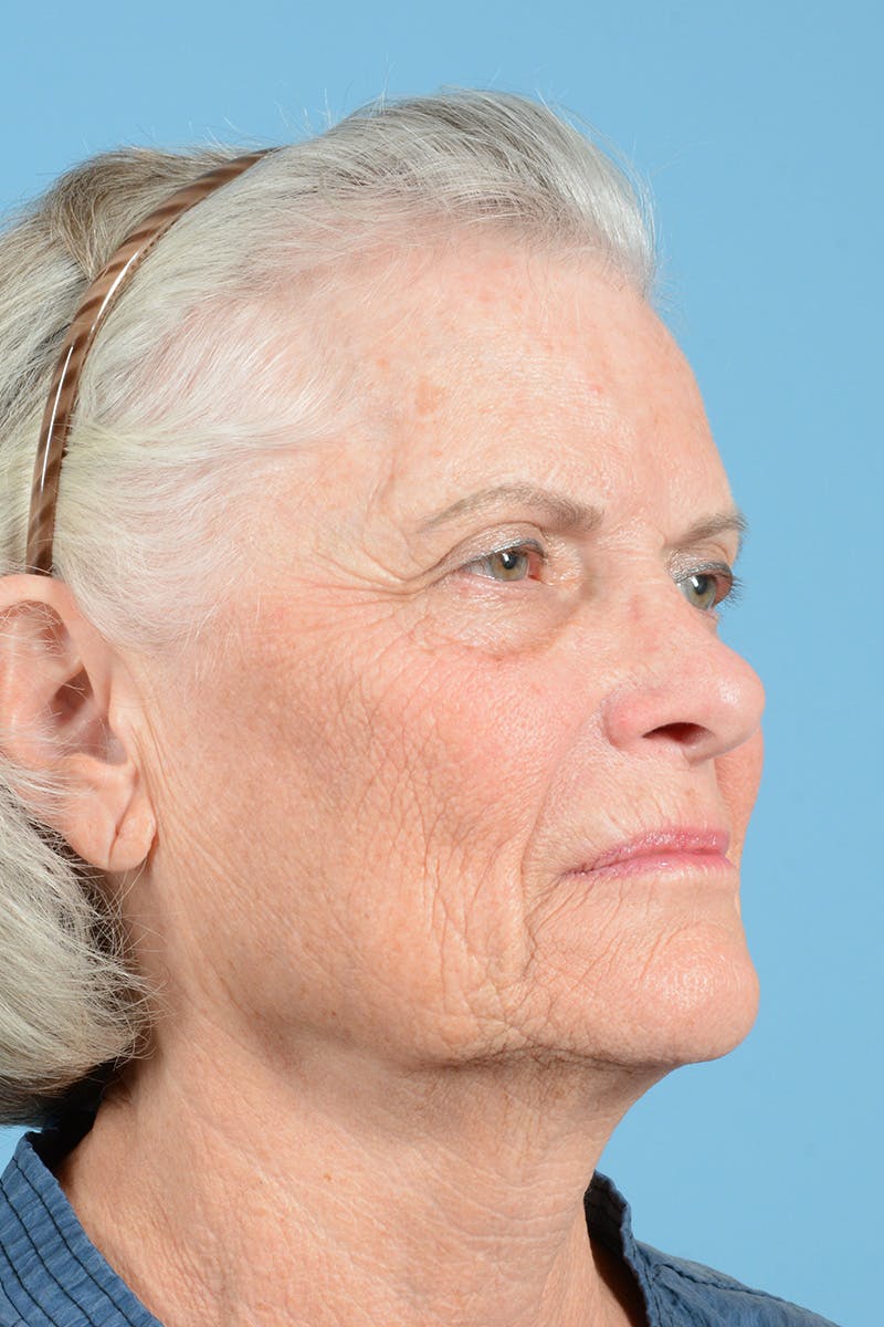 Facelift Before & After Gallery - Patient 734536 - Image 3