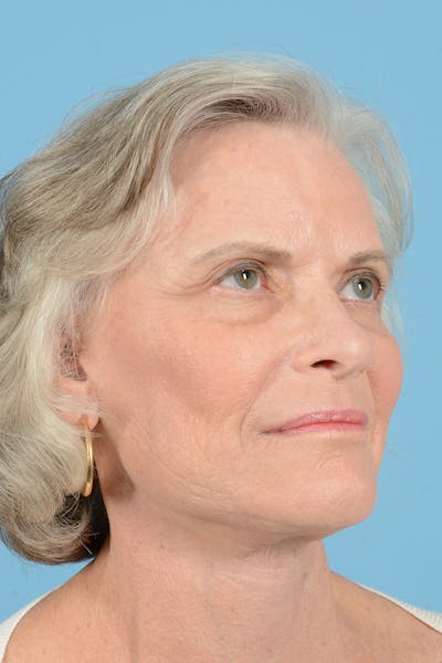 Facelift Before & After Gallery - Patient 734536 - Image 4