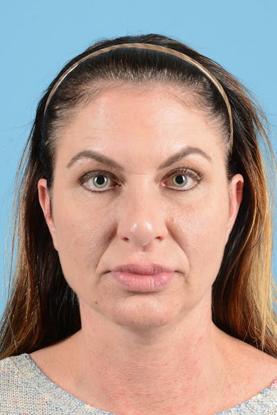 Eyelid Lift Before & After Gallery - Patient 343970 - Image 1