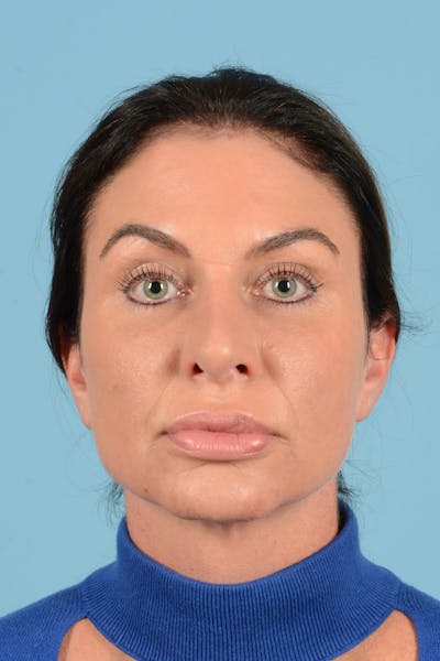 Eyelid Lift Before & After Gallery - Patient 343970 - Image 2